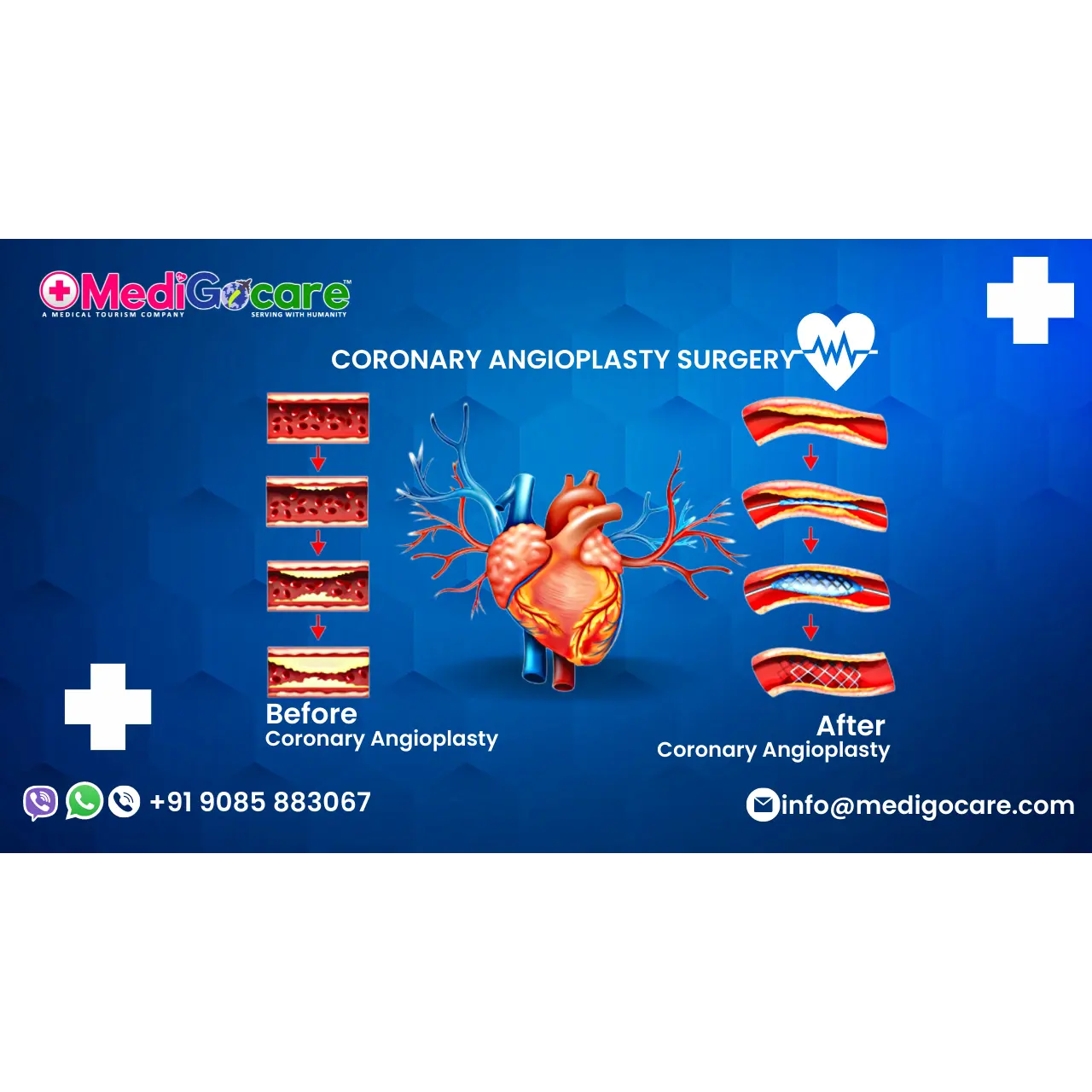 Coronary Angioplasty Treatment Cost in India MediGocare